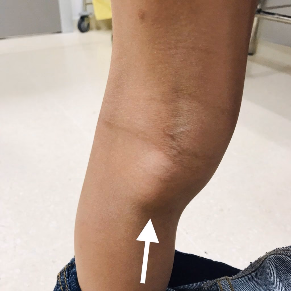 ¿Cómo desinflamar un quiste de Baker?