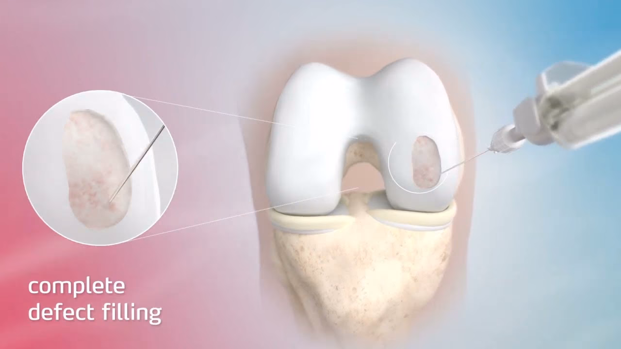 ¿Qué es un chondrofiller?