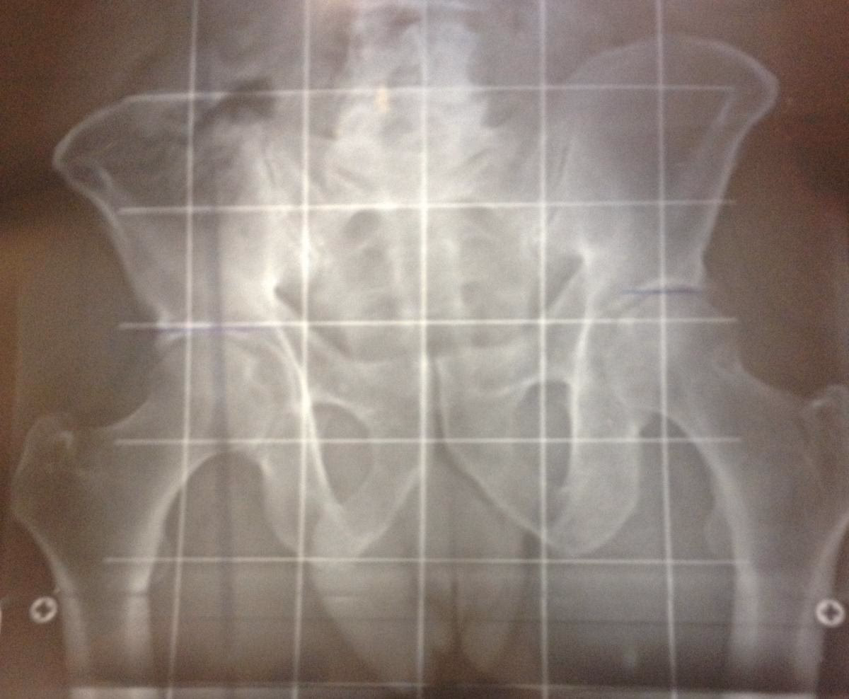 ¿Qué es la dismetría de cadera?