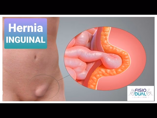 ¿Qué ejercicios no hacer con hernia inguinal?