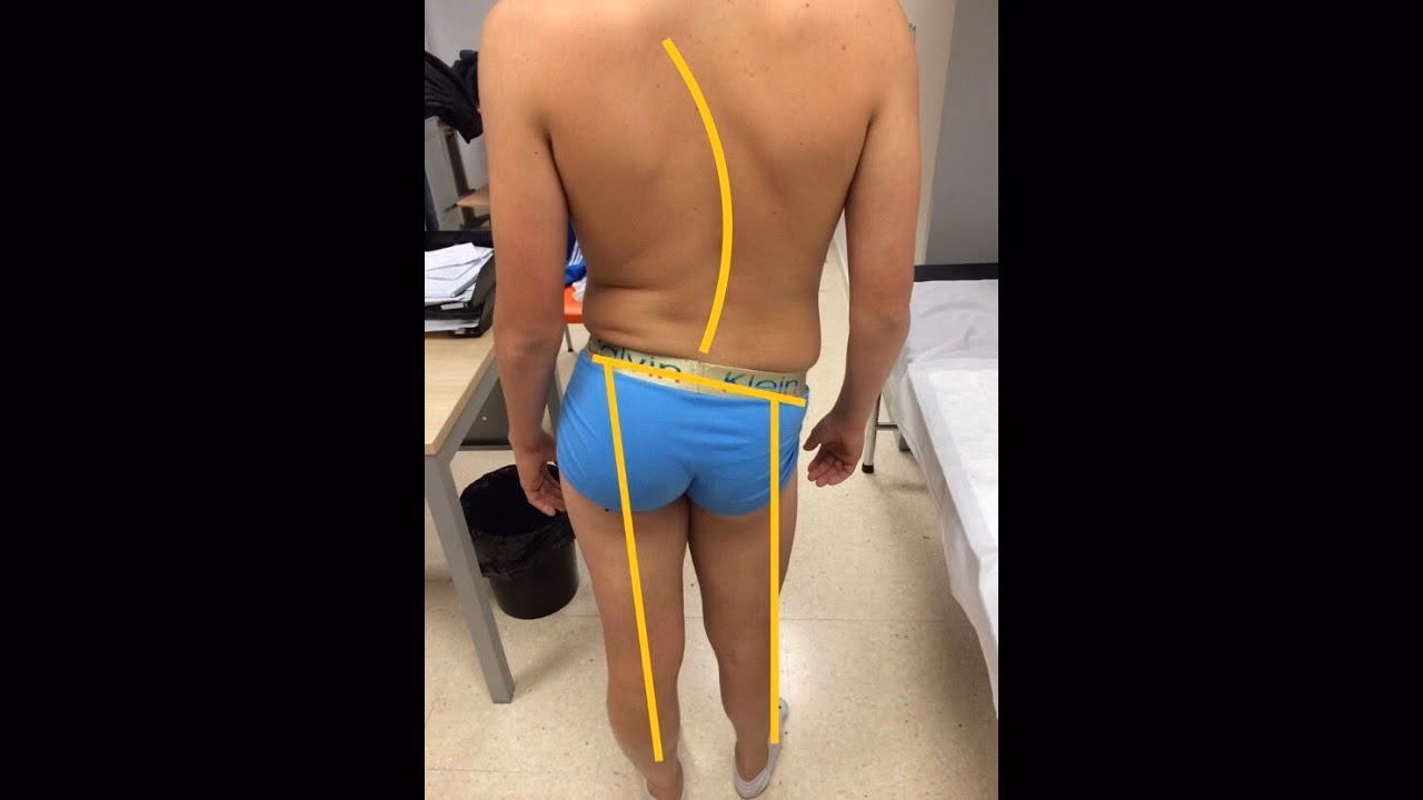 ¿Cuáles son los efectos secundarios de tener una pierna más larga que la otra?