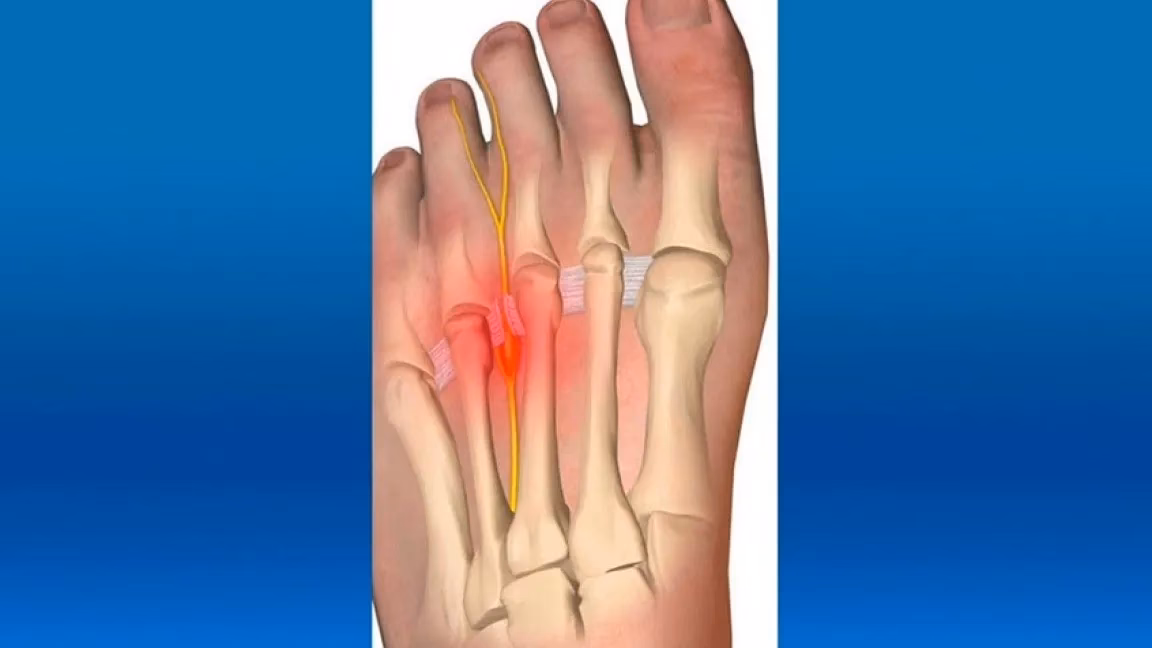 ¿Qué pasa cuando los dedos de los pies se duermen?