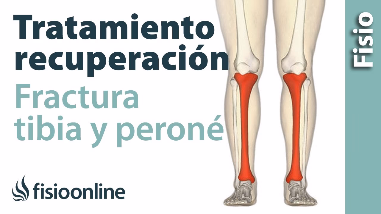 ¿Qué secuelas quedan después de una fractura de tibia y peroné?